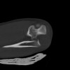 SPORK, NICO - 22.03.1976 - 02.08.2022 - CT obere Extremität - 18:02:23